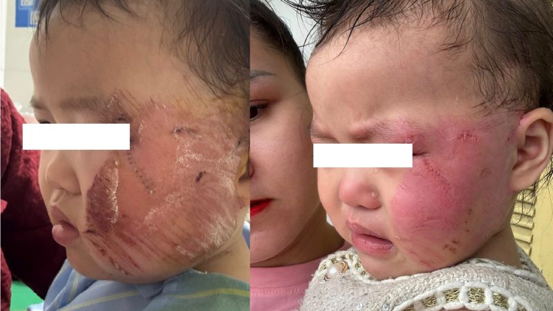 Cận cảnh v.ế.t th.ương của học sinh mầm non bị trần thạch cao rơi đè trúng