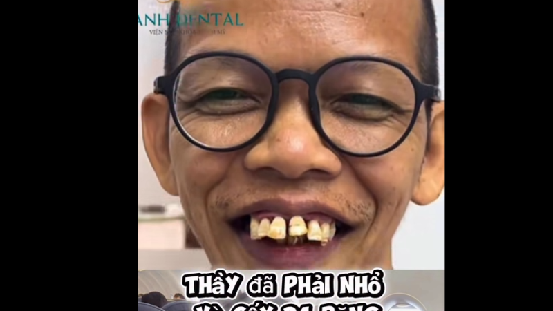 Khầy Nhuận Đạt đã phải nhổ và cấy 24 chiếc răng”. Chi phí khoảng 500 triệu, do Tym hỗ trợ.